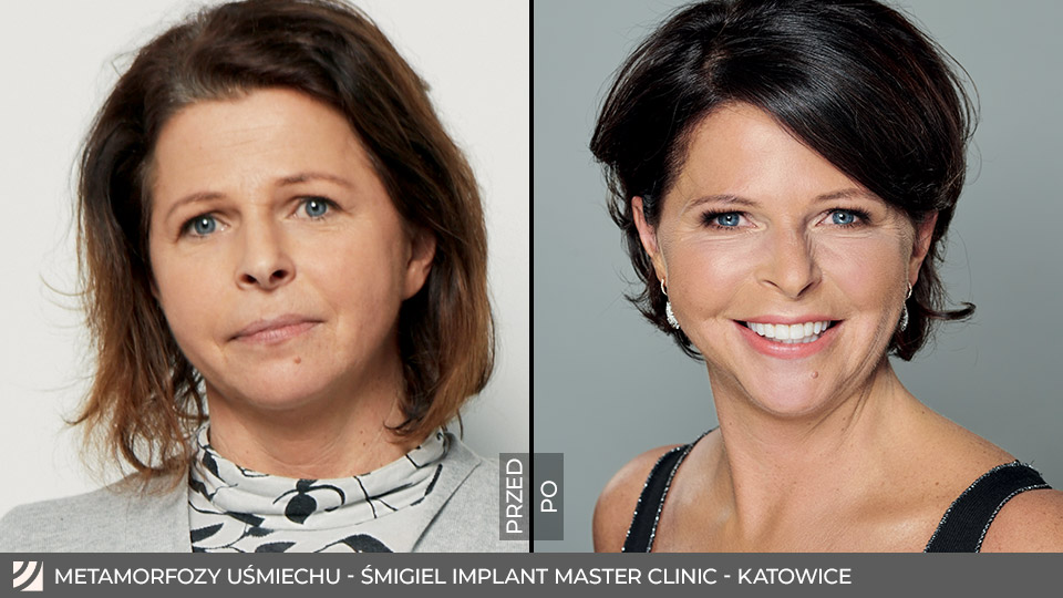 Dwie kobiety przechodzą metamorfozę (metamorfozę) przed i po operacji plastycznej.