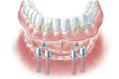 Ilustracja implantu dentystycznego poprawiającego zdolność żucia.