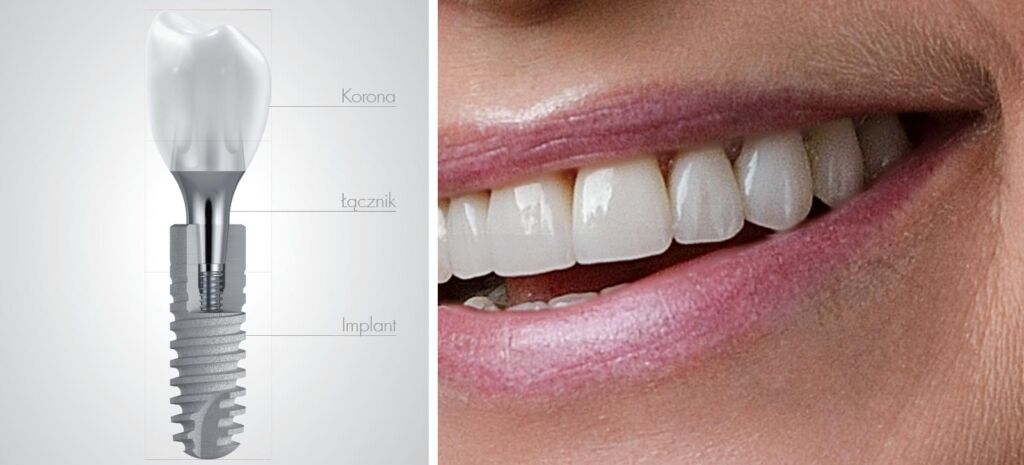 Kobiece zęby są pokazane obok implantu dentystycznego, pokazując koszt implantów zębów.