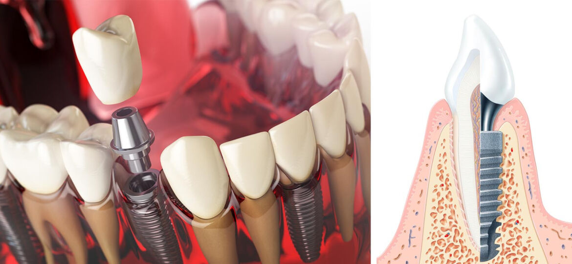 Użyte słowa kluczowe: implanty zębów
Opis: Zdjęcie przedstawiające implanty dentystyczne, trwałe rozwiązanie dla brakujących zębów.