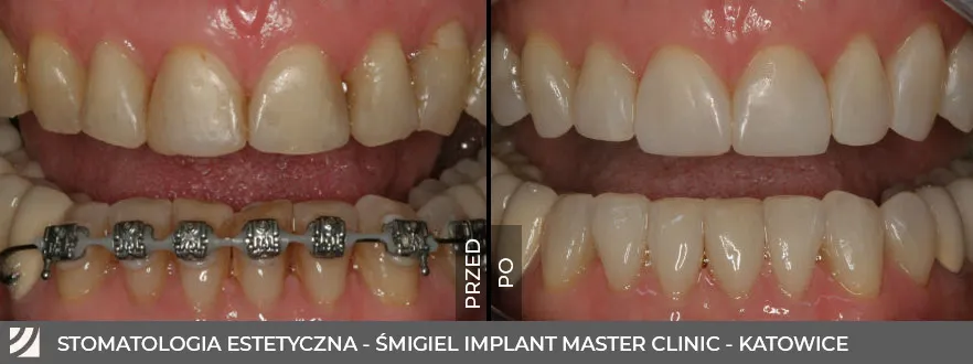 Zdjęcia przed i po przedstawiające przemianę zębów pacjenta poprzez zastosowanie licówek kompozytowych w Katowicach.