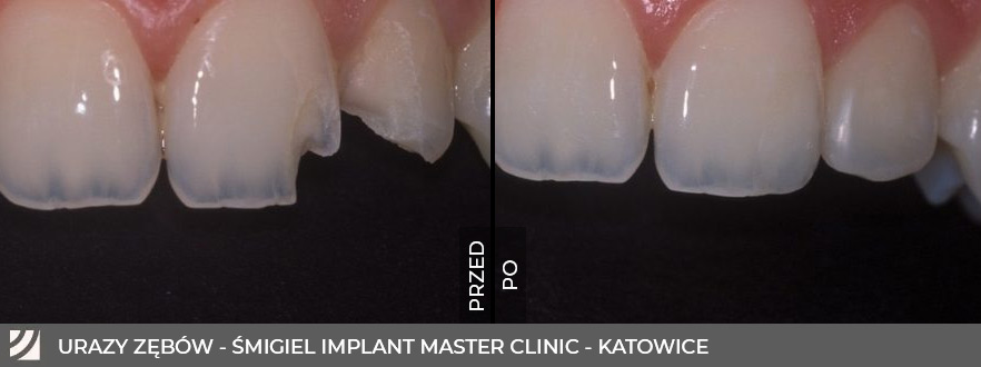 Zdjęcie zęba przed i po zabiegu dentystycznym, przedstawiające Urazy zębów.