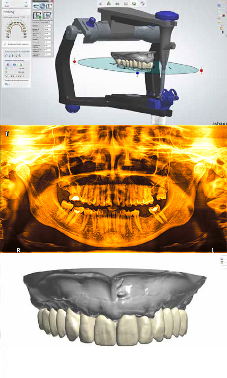 Model dentystyczny i zęby pacjenta przedstawiono w Zębach w jeden dzień.