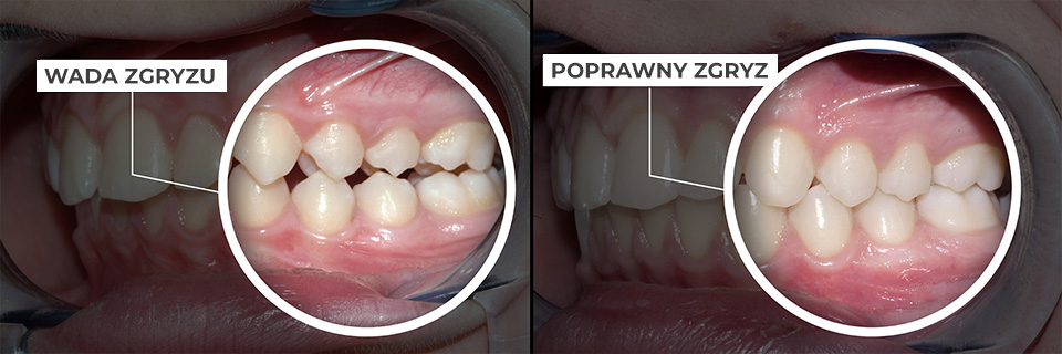 Zdjęcie zębów pacjenta po leczeniu licówkami dentystycznymi w Katowicach.