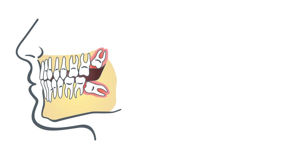 Ilustracja przedstawiająca usta osoby z brakami zębowymi poddawanej „Wyrywaniu ósemek” w Katowicach.