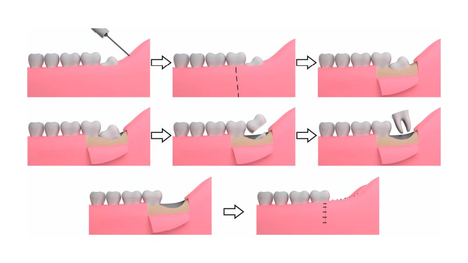 Schemat implantu dentystycznego ilustrujący etapy ekstrakcji zęba w Katowicach.